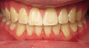 Before and After - Alvarez Orthodontics | Bethlehem Center Valley PA